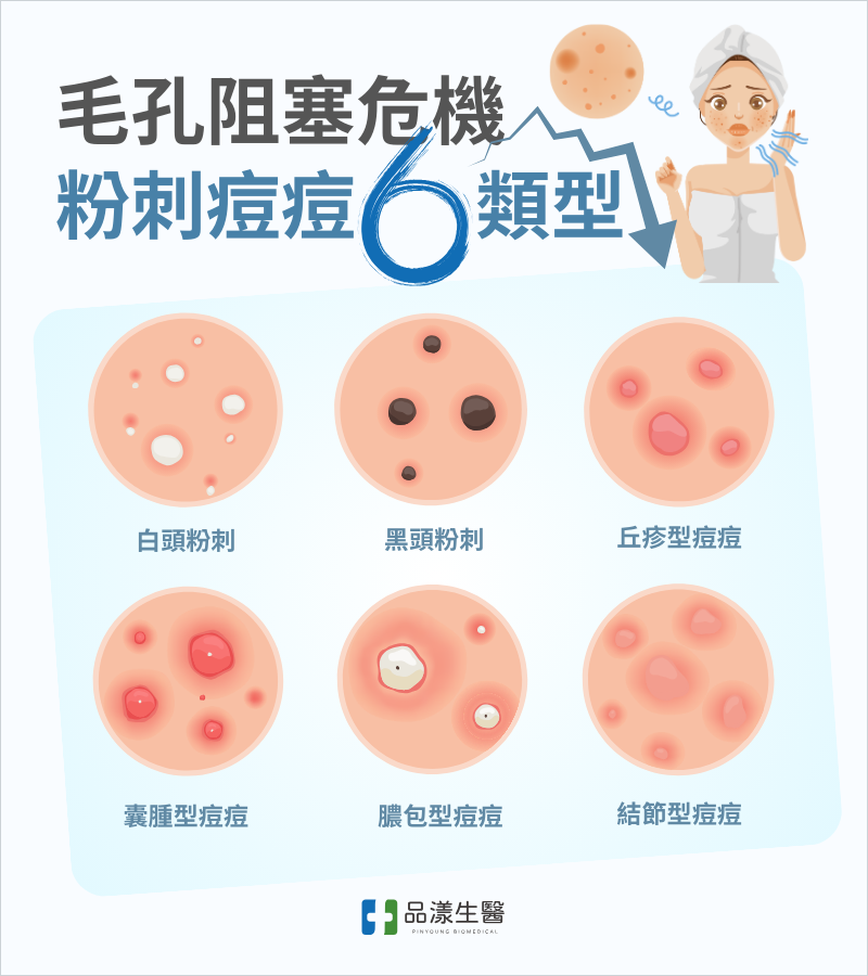 毛孔阻塞危機粉刺痘痘6大類型