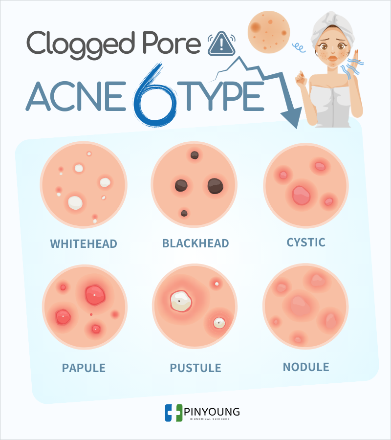 毛孔阻塞危機粉刺痘痘6大類型